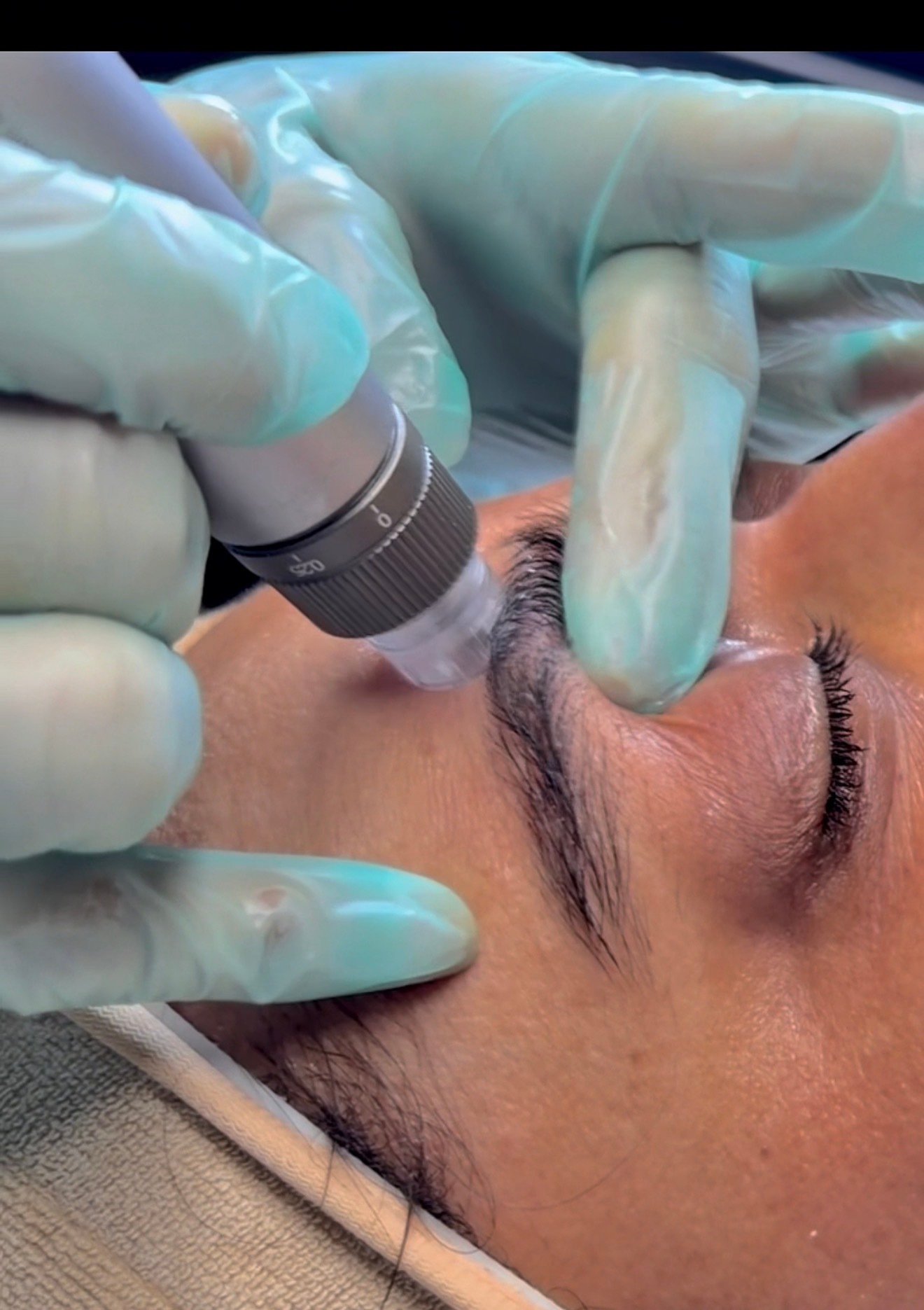 Cellular Renewal RF Microneedling Facial